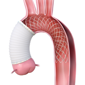 AMDS™ Hybrid Prosthesis – Artivion